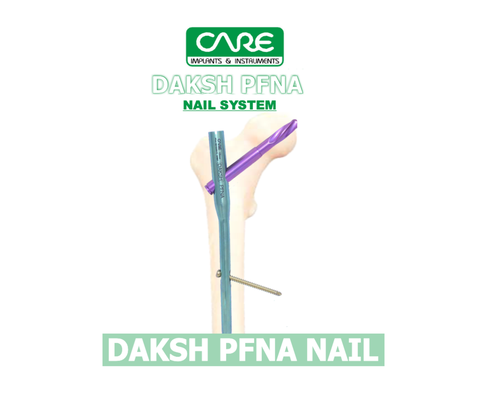 DAKASH PROXIMAL FEMORAL NAIL ANTIROTATION (PFNA)